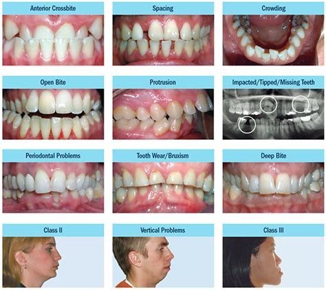 bite 18 cm|7 Common Types of Bite Problems and Their Orthodontic Solutions.